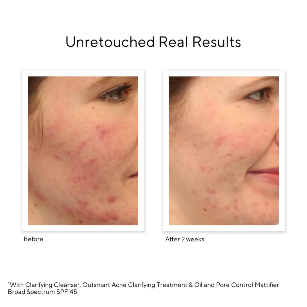 Best Cleanser for Acne-Prone Skin 2025