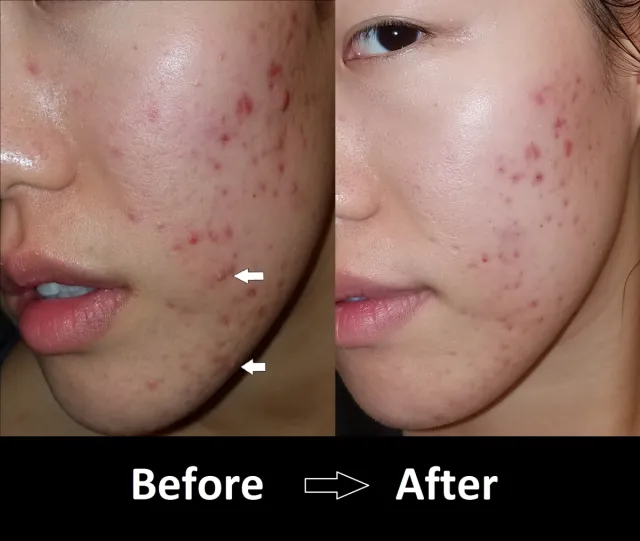 Best Cleanser for Acne-Prone Skin 2025